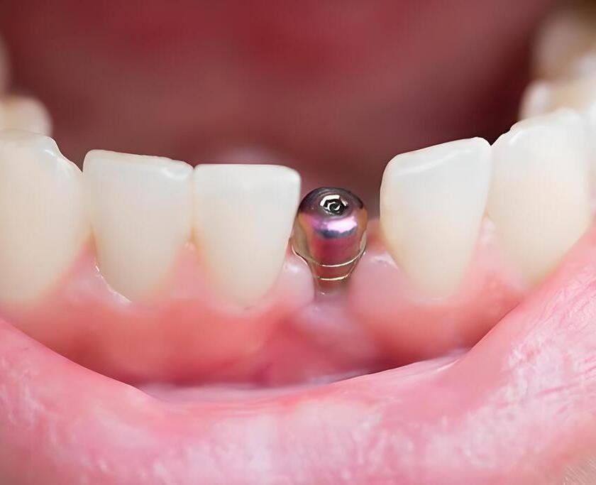 vista cenital tornillo diente post implante min vista cenital tornillo diente post implante min