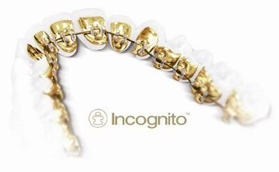 Ortodoncia lingual en Quintana y Ventas