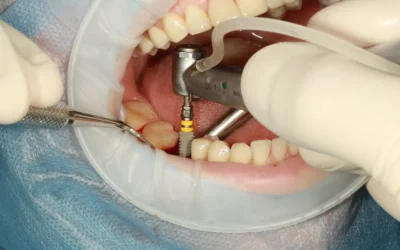 Mucositis periimplantaria
