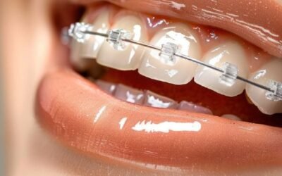 Brackets Transparentes: lo que necesitas saber