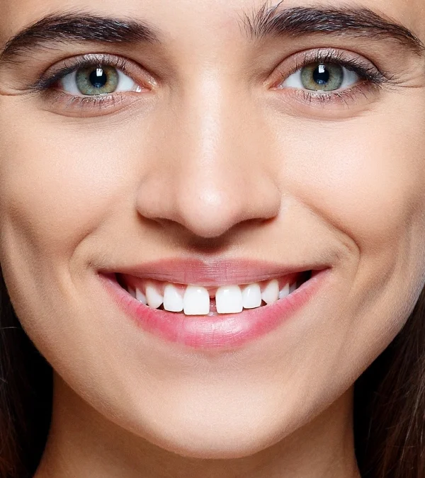 Diastema: Qué es y cómo corregirlo en nuestras clínicas dentales en Madrid