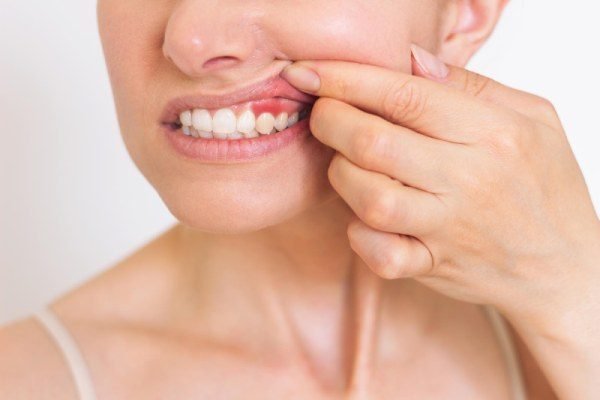 ¿Qué es la gingivitis y cómo puedes tratarla?
