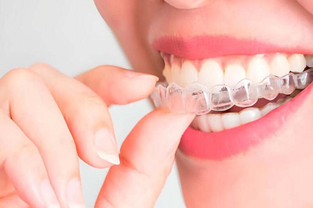 dentist-blog-02 ortodoncia ferula de contencion garantia dental